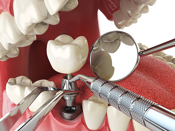 Best Emergency Wisdom Tooth Extraction in Lewisburg, WV